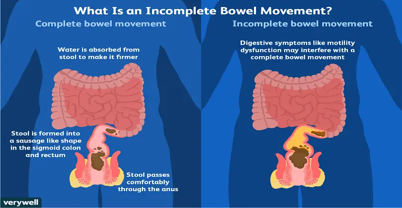 Constipation – Causes, Risk Factors, and Treatment