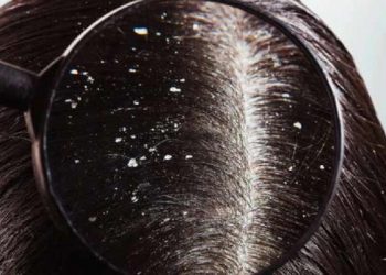 09 Best Home Remedies for Dandruff. Get Rid of Dandruff Naturally & Easily!